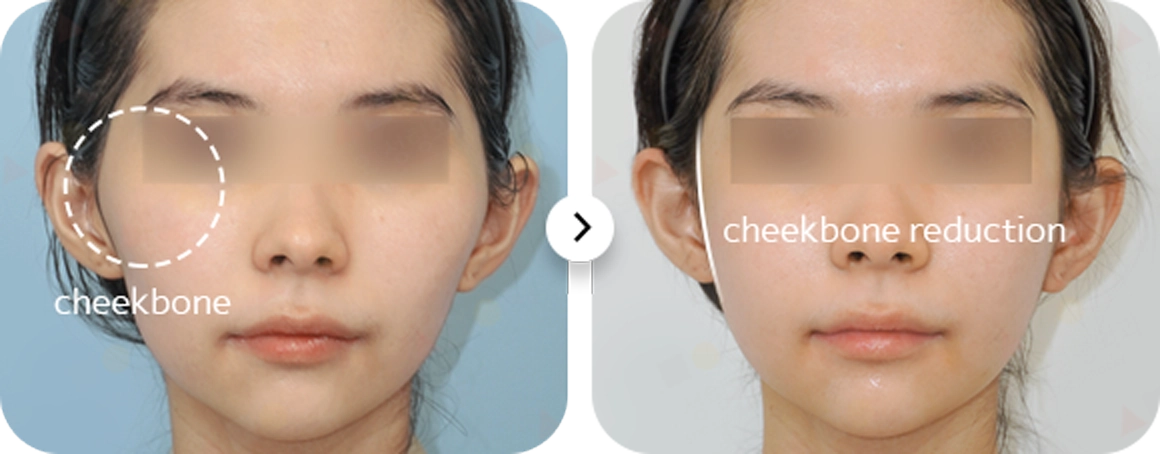 345 Plastic Surgery cheekbone reduction before and after for natural results.
