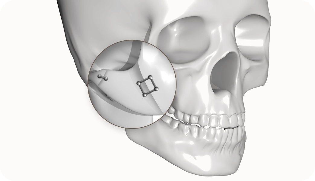 Skull with zygomatic implant for 345 plastic surgery where natural.