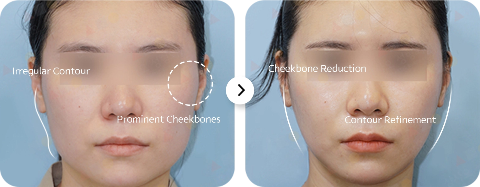 Cheekbone reduction before and after 345 plastic surgery for natural contour refinement.
