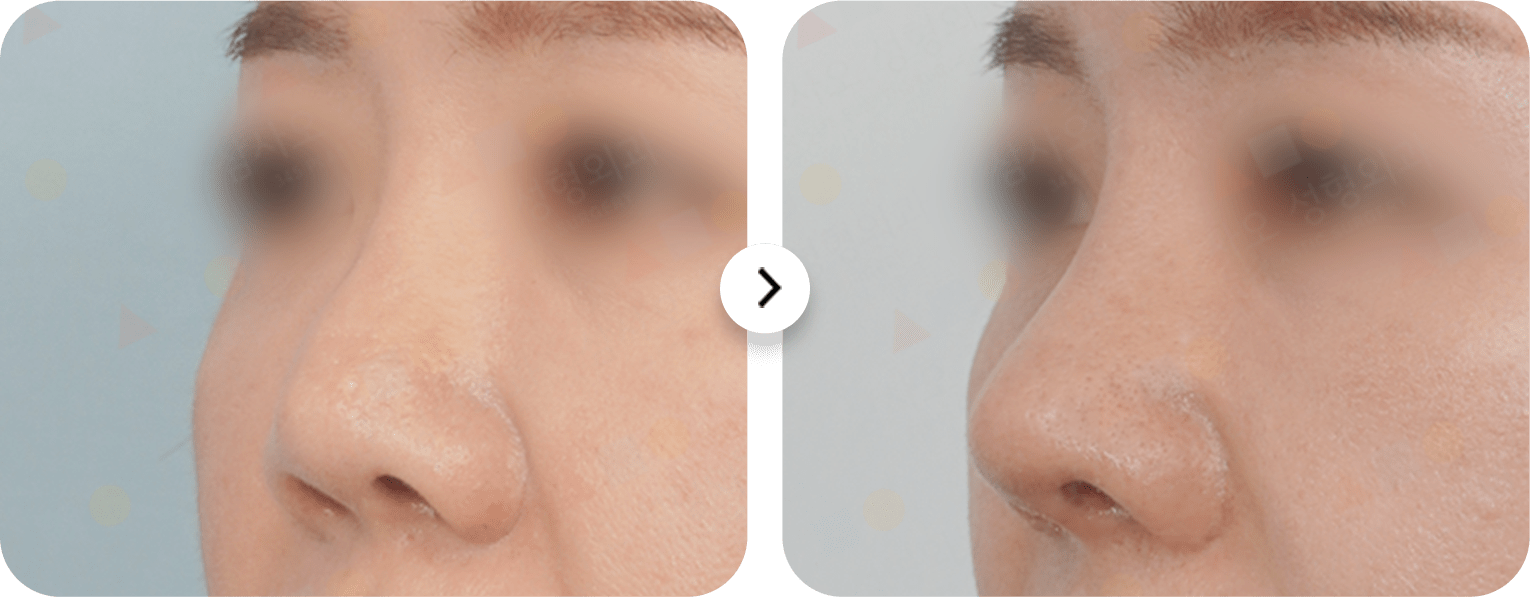 Rhinoplasty before and after showing natural results. 345 Plastic Surgery for nose reshaping where natural.