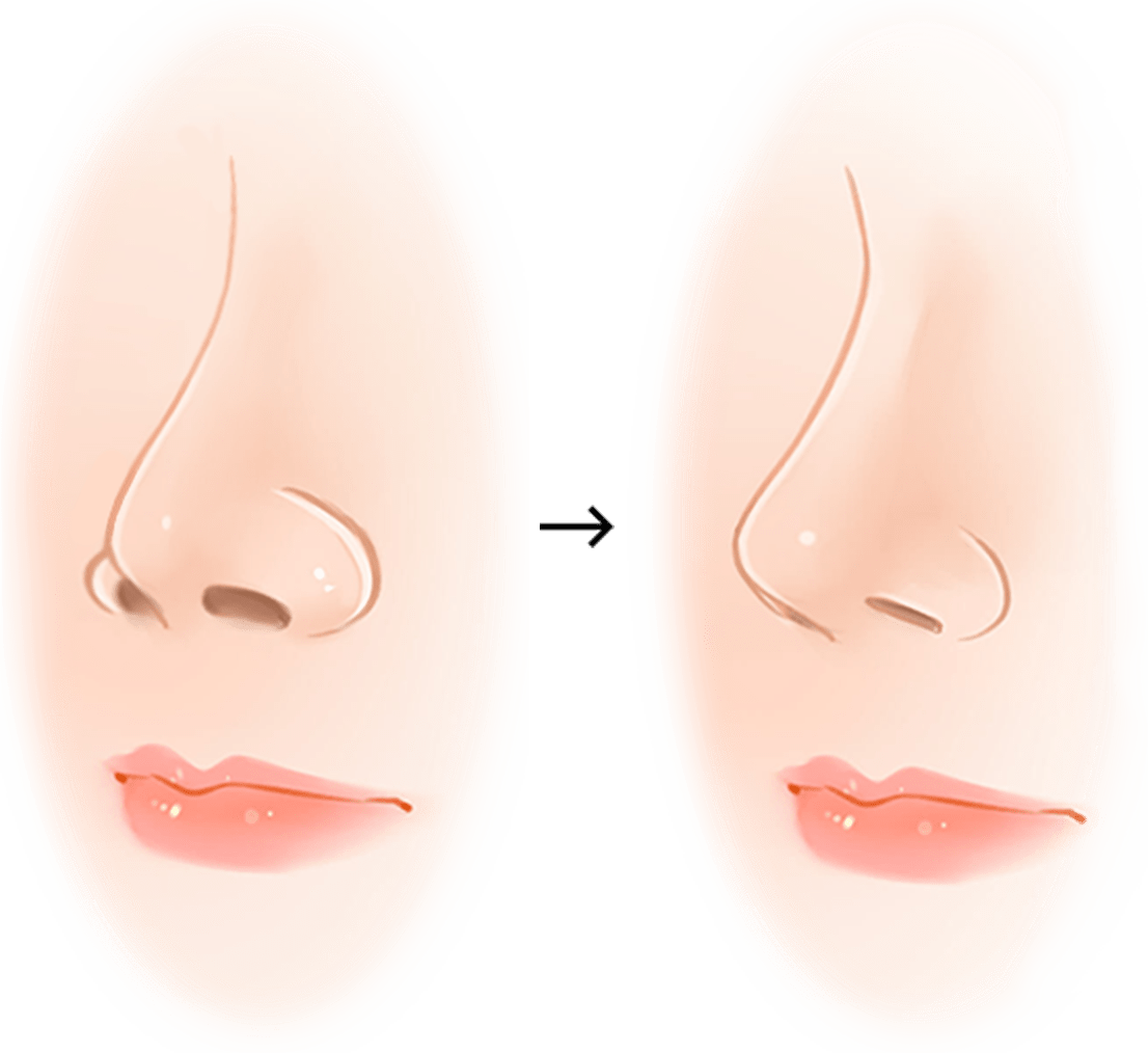 345 Plastic Surgery where natural nose job before and after plastic surgery