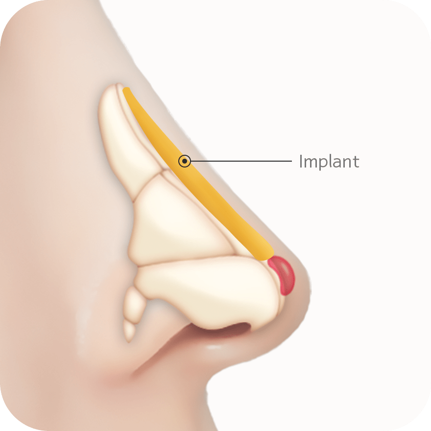 Nose implant diagram for 345 plastic surgery where natural results are key