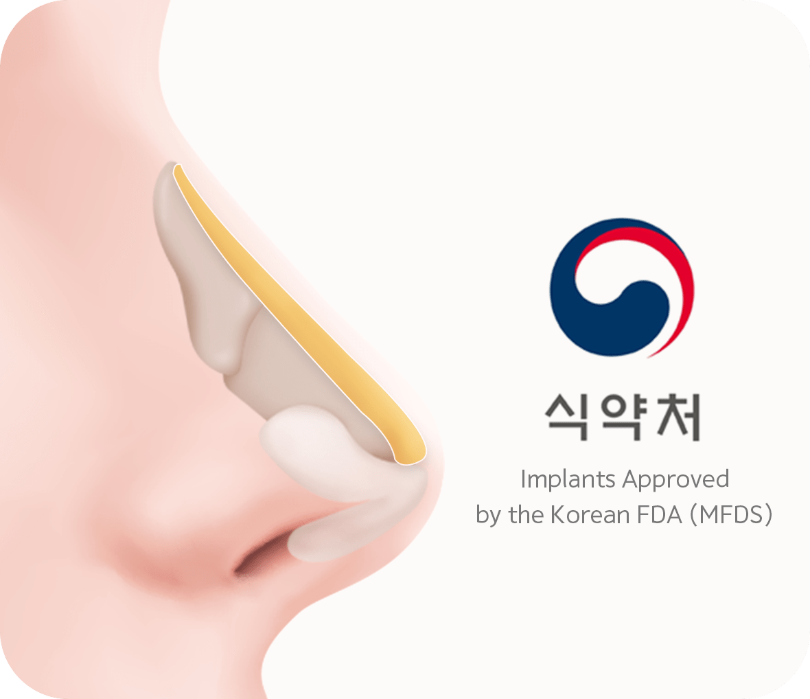Natural looking 345 Plastic Surgery with nose implant approved by Korean FDA MFDS