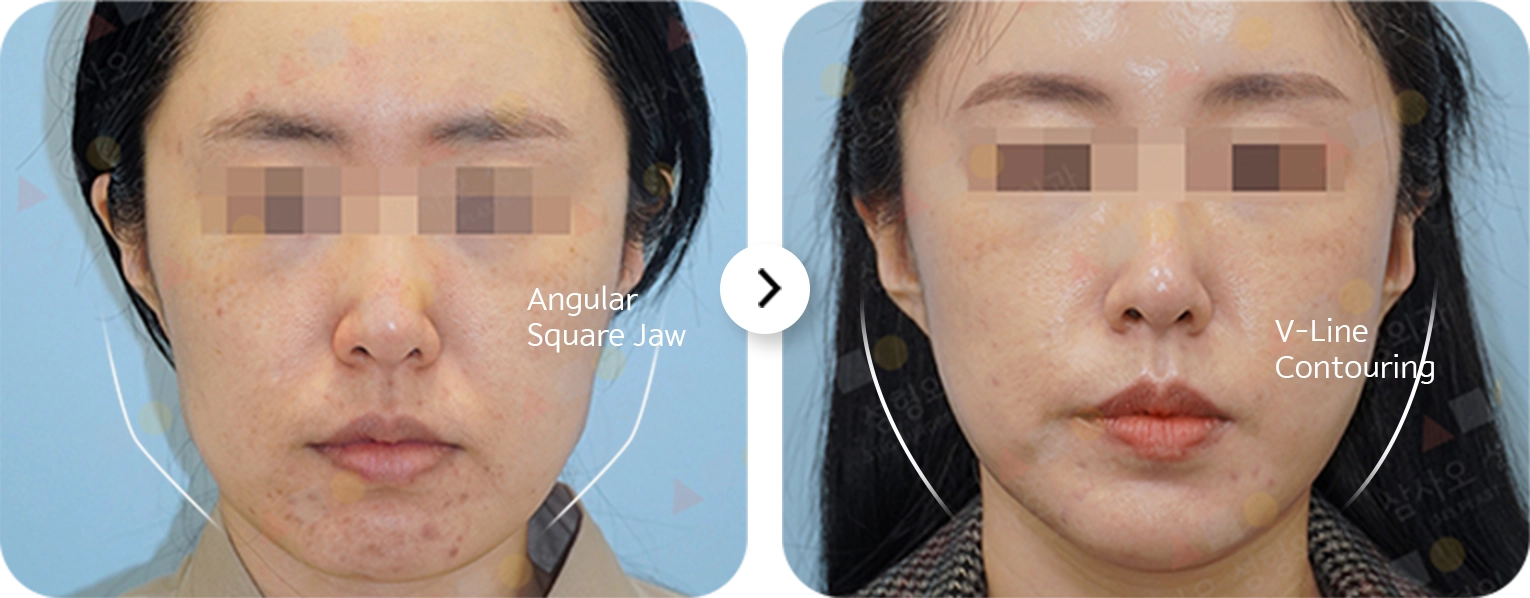 Before and after 345 Plastic Surgery showing V-Line Contouring and angular square jaw where natural.