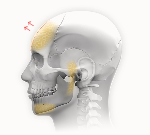 345 Plastic Surgery where natural skull anatomy for plastic surgery showing bone structure and lift areas
