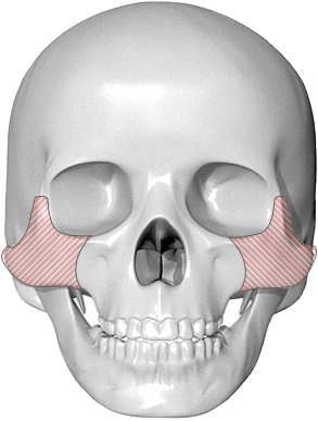 345 Plastic Surgery skull showing zygomatic bone for natural facial contouring