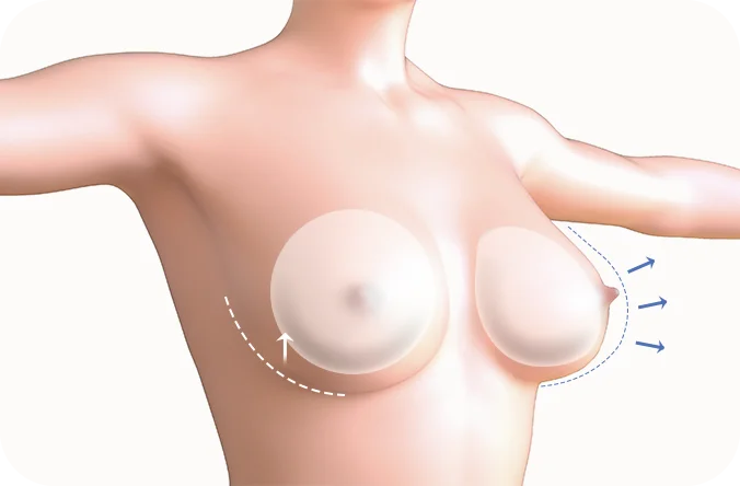 345 Plastic Surgery diagram showing natural breast augmentation lift procedure.
