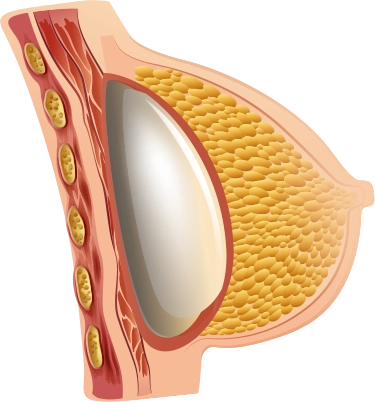 Breast implant diagram for 345 plastic surgery where natural results are desired.
