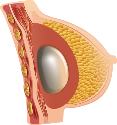 Breast implant anatomy for 345 plastic surgery where natural results.