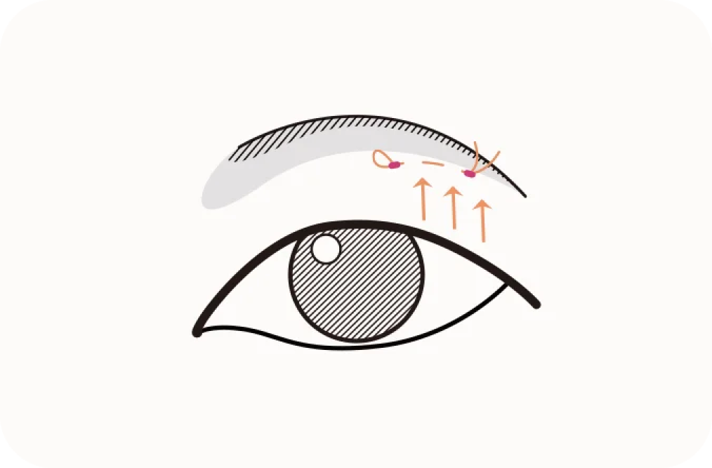 Eyebrow lift plastic surgery diagram showing natural results 345.