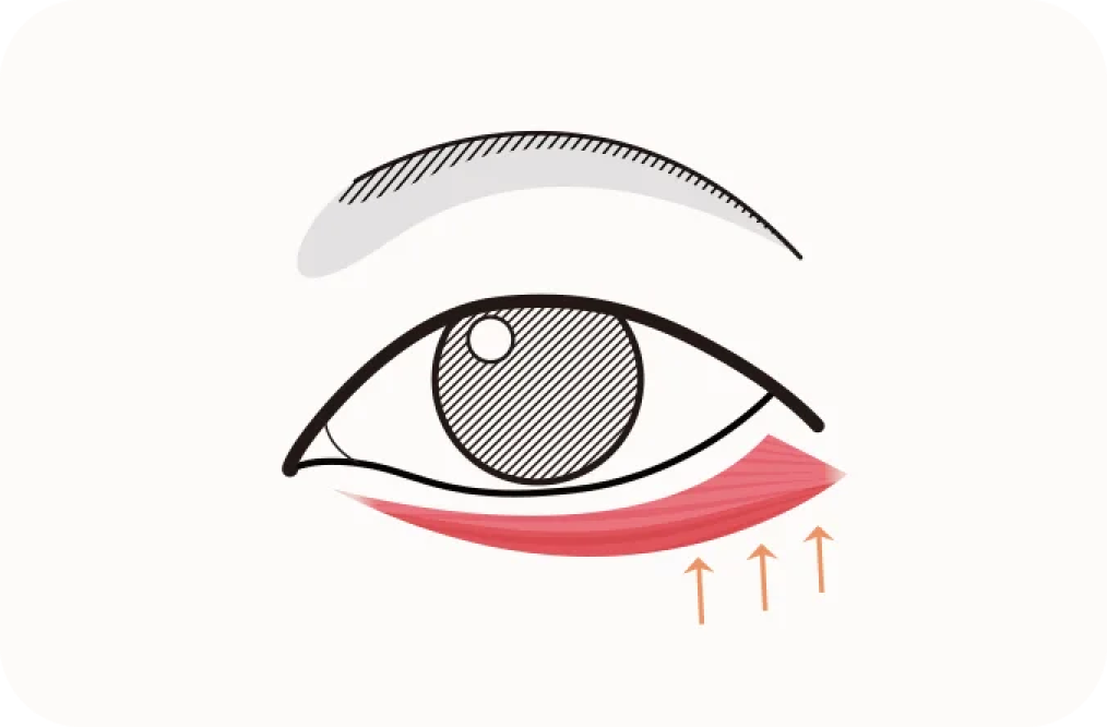 Eye illustration showing muscle lift for plastic surgery. 345 Plastic Surgery where natural.