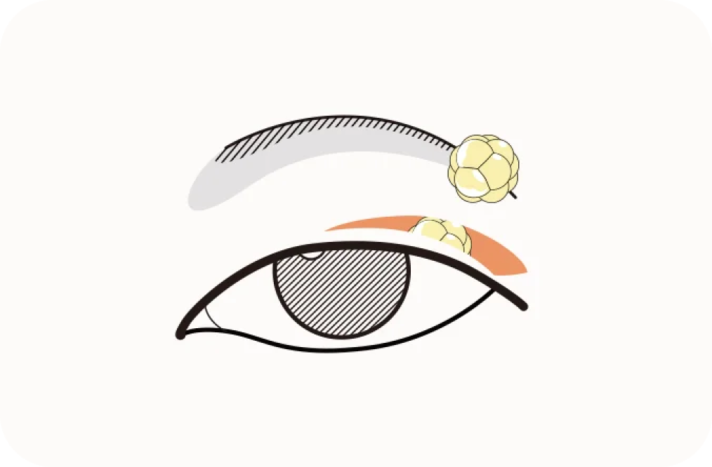 Eye with under eye bags illustration for 345 Plastic Surgery where natural results are achieved.