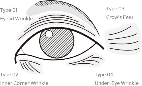 Eye wrinkle types diagram for 345 plastic surgery where natural results.