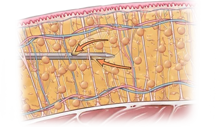 345 Plastic Surgery where natural liposuction diagram showing fat removal.