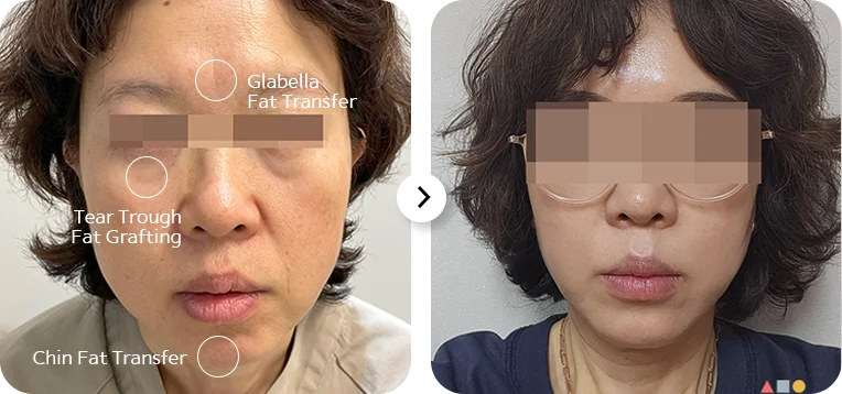 Before and after 345 plastic surgery fat transfer to glabella tear trough chin for natural results.
