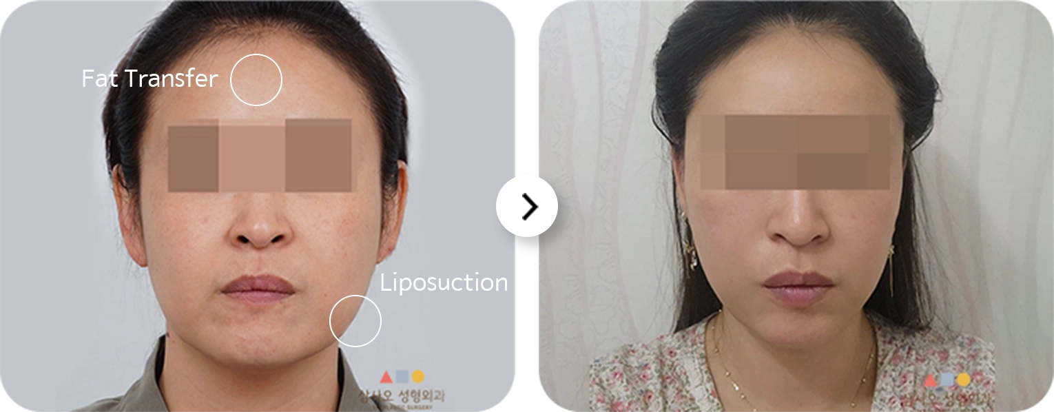 Before and after 345 plastic surgery showing natural results with fat transfer and liposuction.
