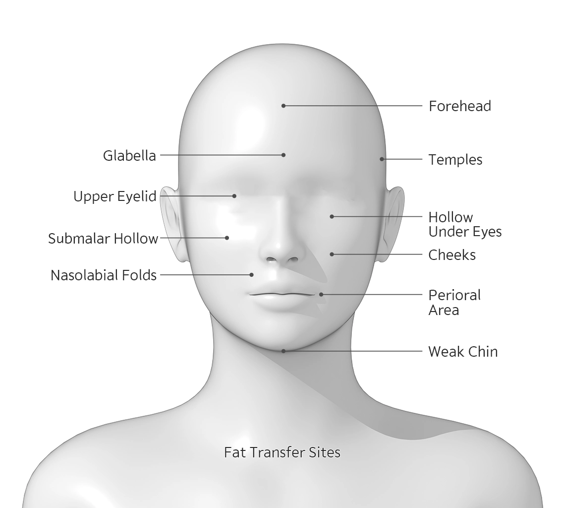 Facial fat transfer sites for natural 345 plastic surgery: forehead, eyes, cheeks, chin.