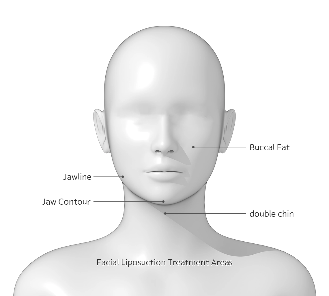 Facial liposuction treatment areas jawline buccal fat double chin 345 plastic surgery where natural