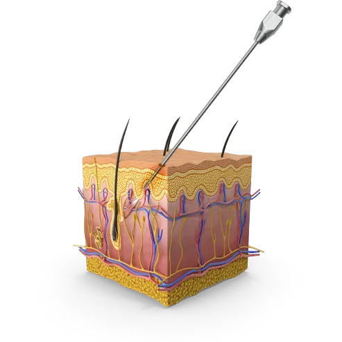 345 Plastic Surgery needle injecting skin layer for natural plastic surgery.