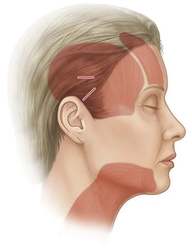 345 Plastic Surgery diagram showing facial muscles for natural plastic surgery results