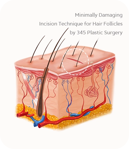 Minimally Damaging Incision Technique for Hair Follicles by 345 Plastic Surgery where natural