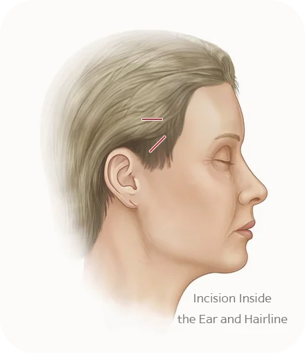 345 Plastic Surgery incision inside ear and hairline for natural plastic surgery.