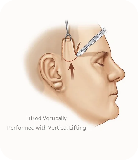 345 plastic surgery where natural face lift incision diagram. Vertical lifting plastic surgery.