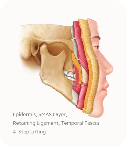 Anatomy of face showing layers for plastic surgery where natural 345 face lift.