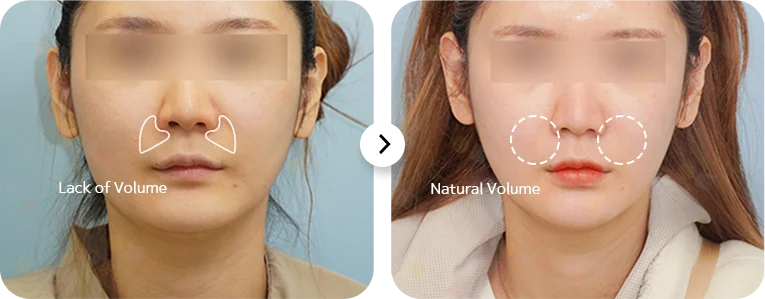 345 Plastic Surgery before and after cheek volume, natural look. Volume restored with plastic surgery.
