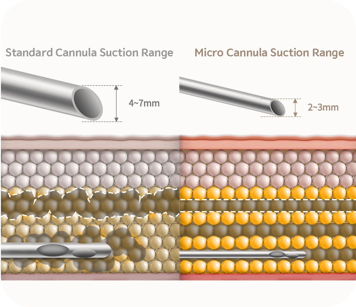 Plastic surgery cannula suction range comparison for natural 345 results. Micro vs standard cannula sizes.
