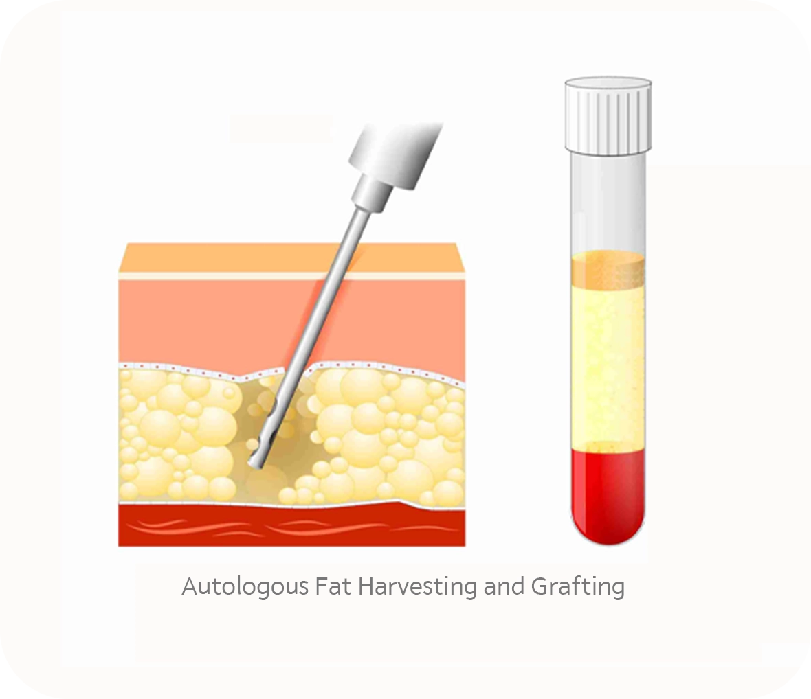 345 Plastic Surgery showing fat harvesting for natural autologous fat grafting procedure