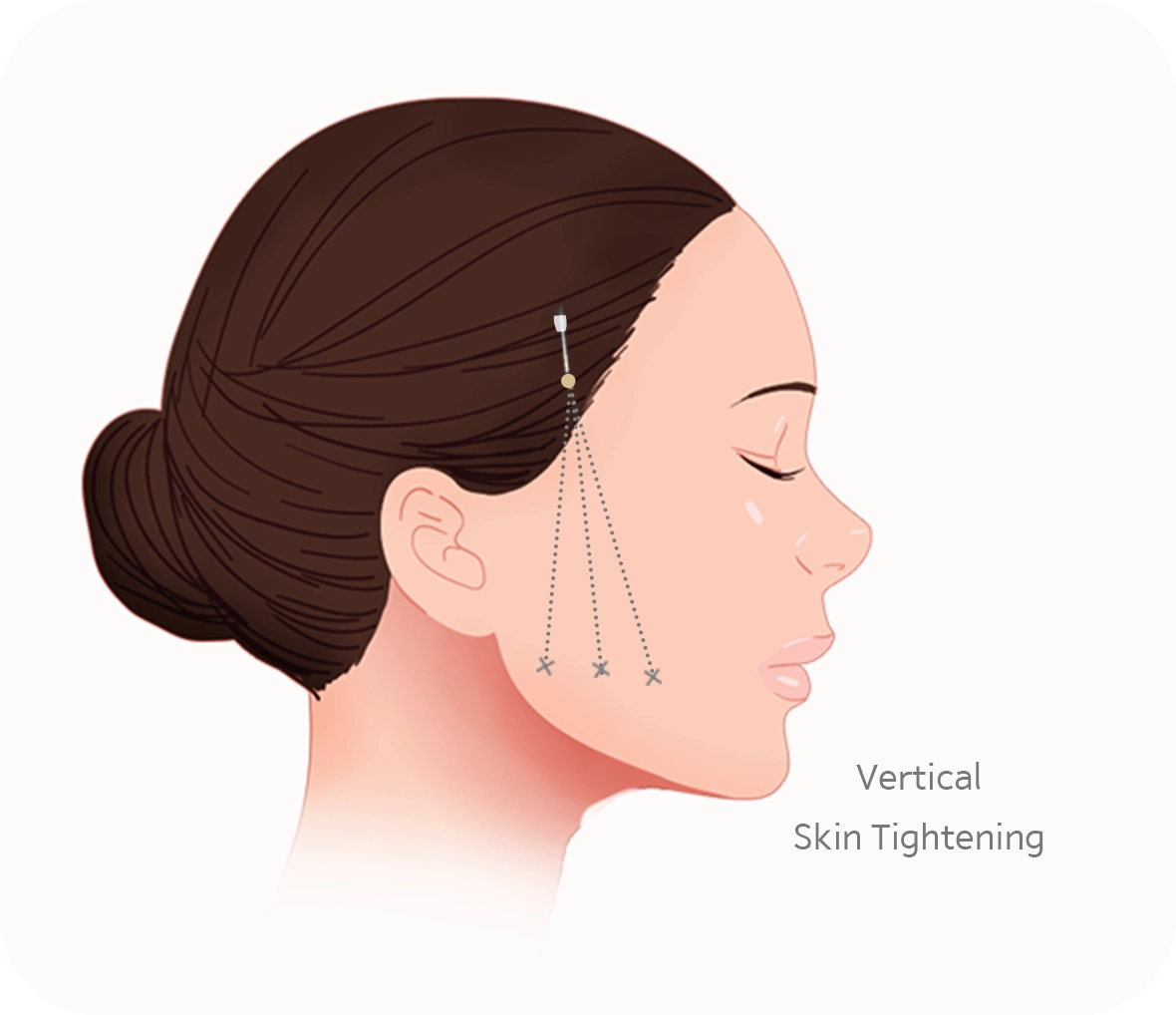 Vertical skin tightening procedure for natural 345 plastic surgery results.
