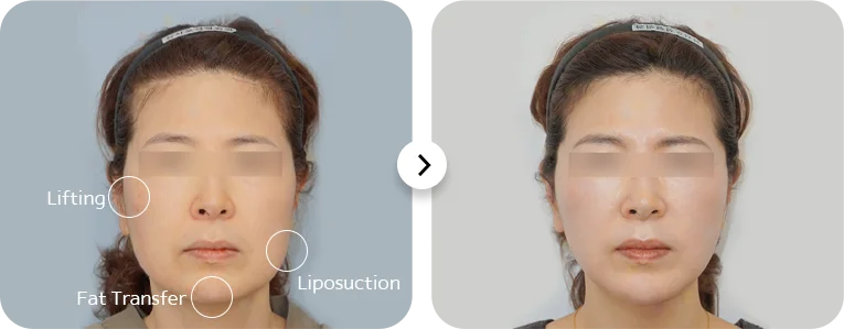 Before and after 345 plastic surgery for natural face lifting, liposuction, and fat transfer.