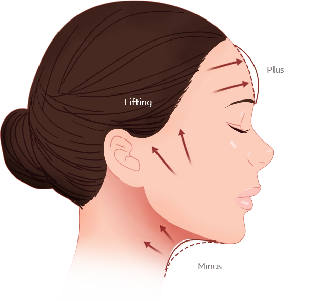 Facelift diagram showing lifting plus minus areas for plastic surgery where natural 345.