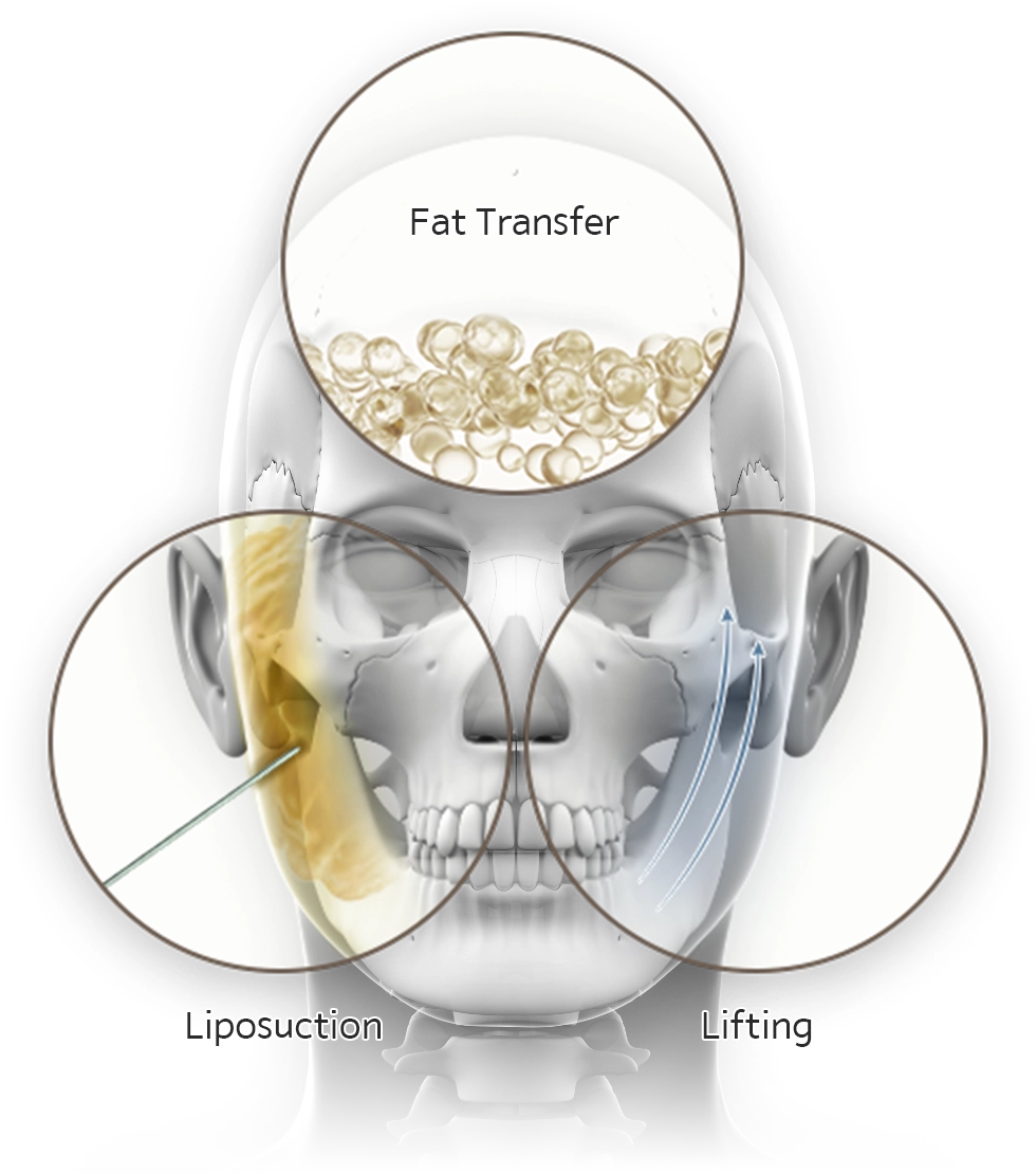 345 Plastic Surgery illustration of fat transfer liposuction and lifting for natural results