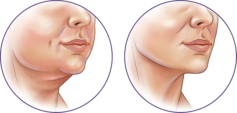 Before and after 345 plastic surgery where natural, showing neck lift results. Plastic surgery for a youthful look.