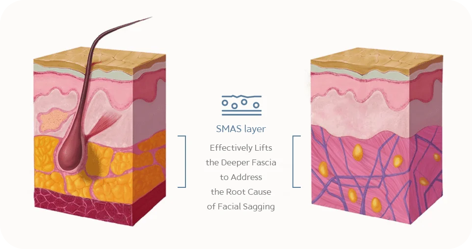 SMAS layer diagram for 345 Plastic Surgery. Facial sagging addressed with deeper fascia lift where natural.