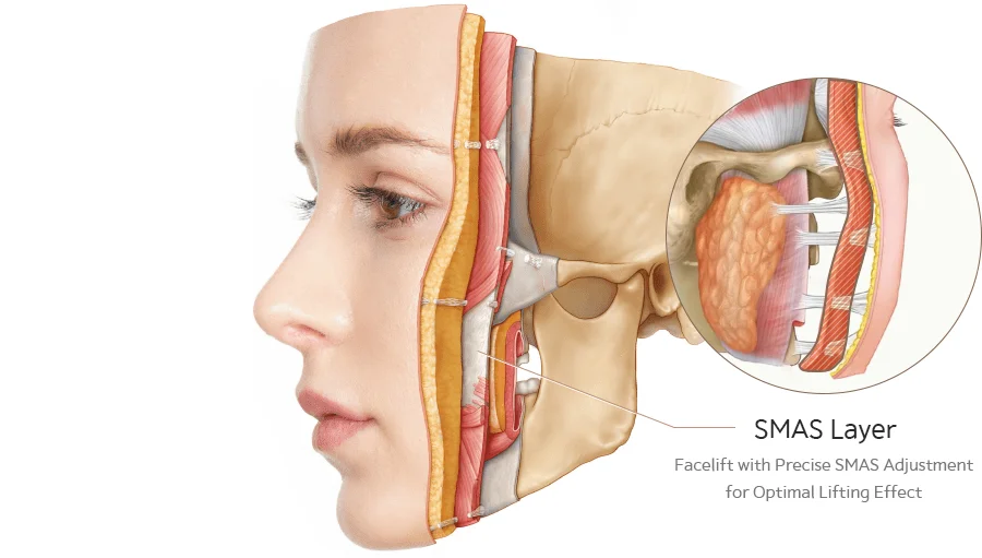 345 Plastic Surgery SMAS facelift diagram showing natural face layers and adjustment for optimal lifting effect