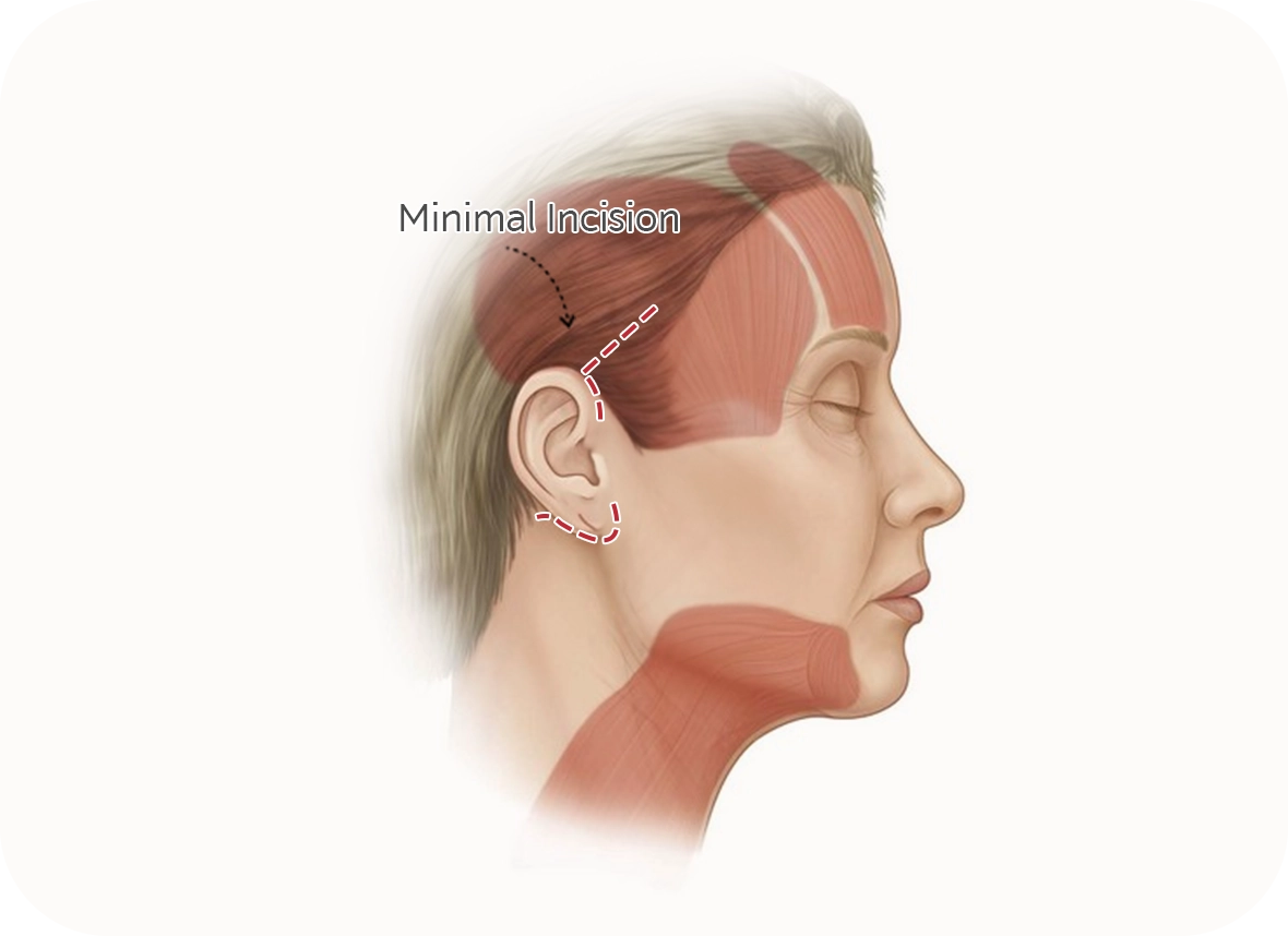 Minimal incision plastic surgery diagram showing where natural 345 plastic surgery is performed.