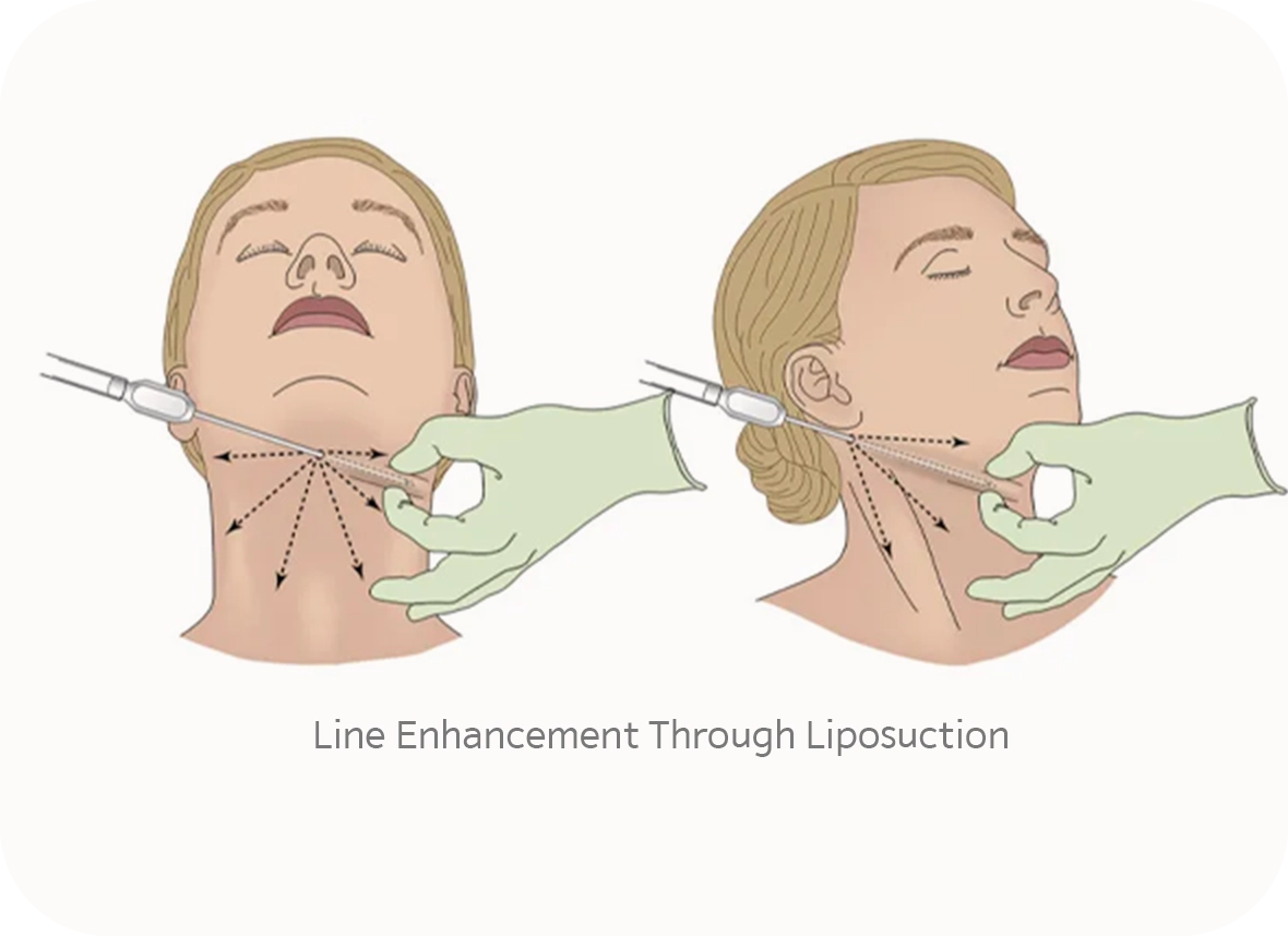 345 Plastic Surgery neck liposuction for line enhancement where natural cosmetic procedure.