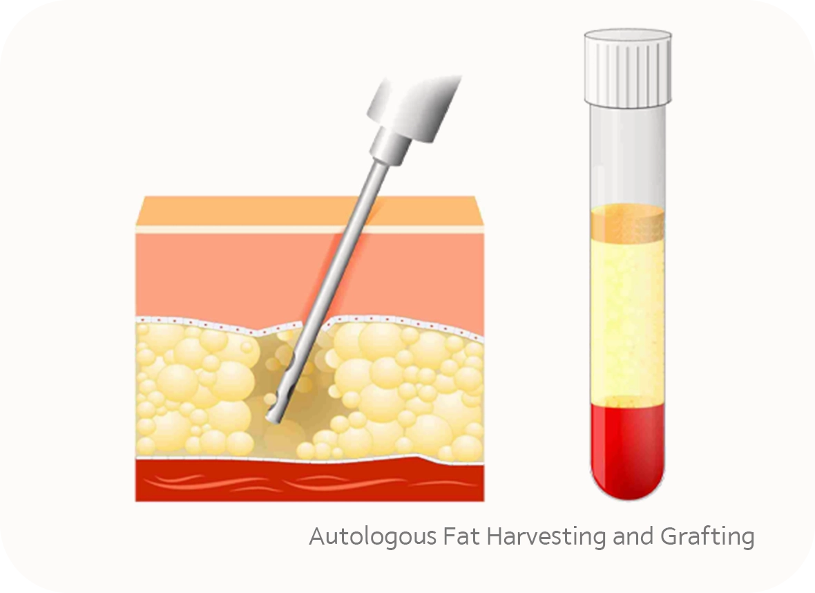 345 Plastic Surgery fat harvesting. Natural plastic surgery with autologous fat grafting.
