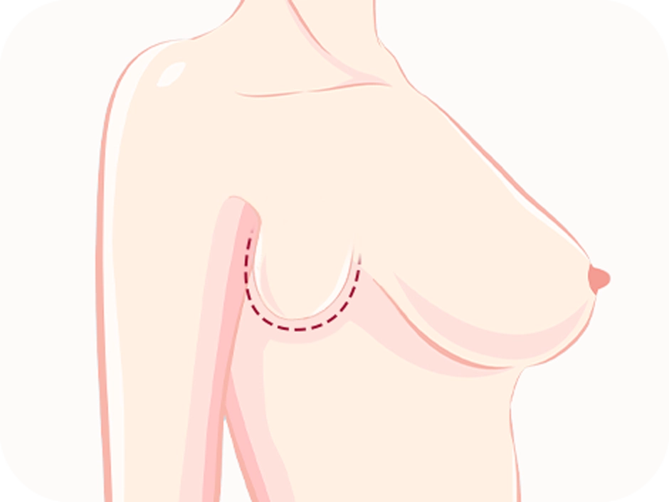 Breast lift diagram for plastic surgery where natural results are desired
