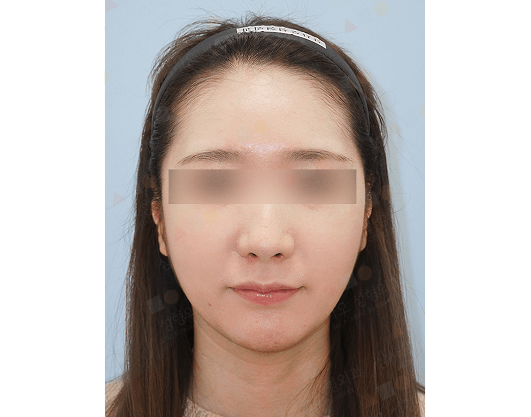 Asian woman face front view, natural 345 plastic surgery example.