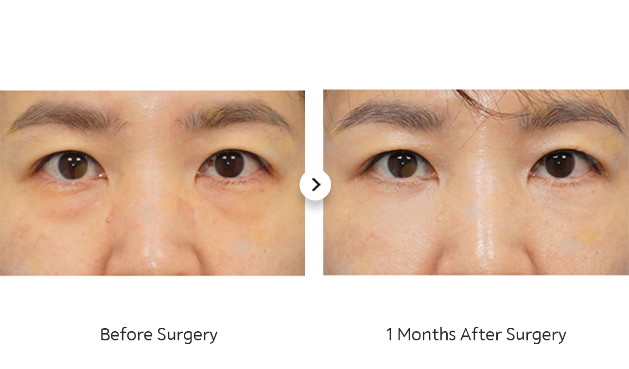 Before and after 345 plastic surgery for natural looking eyes.