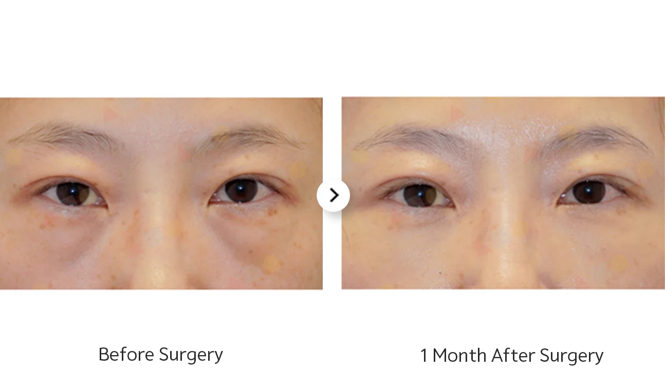 Before and after 345 plastic surgery eyes, showing natural results.