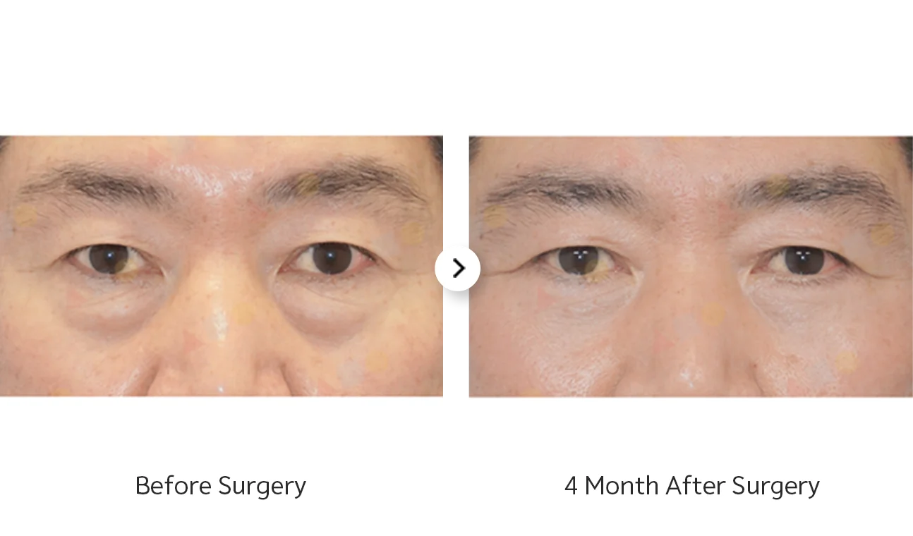 345 Plastic Surgery before and after eyes, where natural results were achieved.