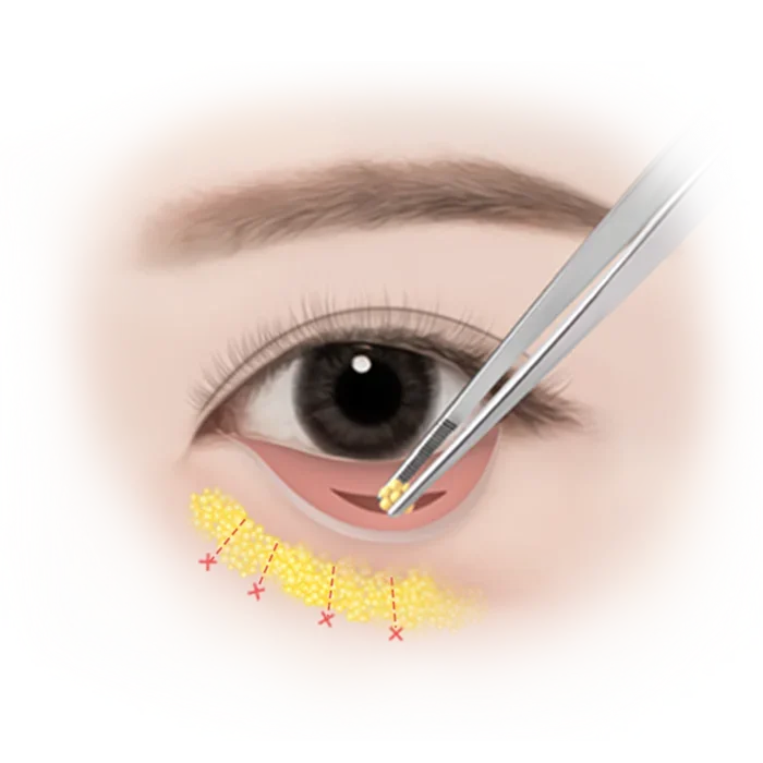 Brighten Tired Eyes With Lower Eyelid Surgery At 345 Brighten Tired Eyes With Lower Eyelid Surgery At 345