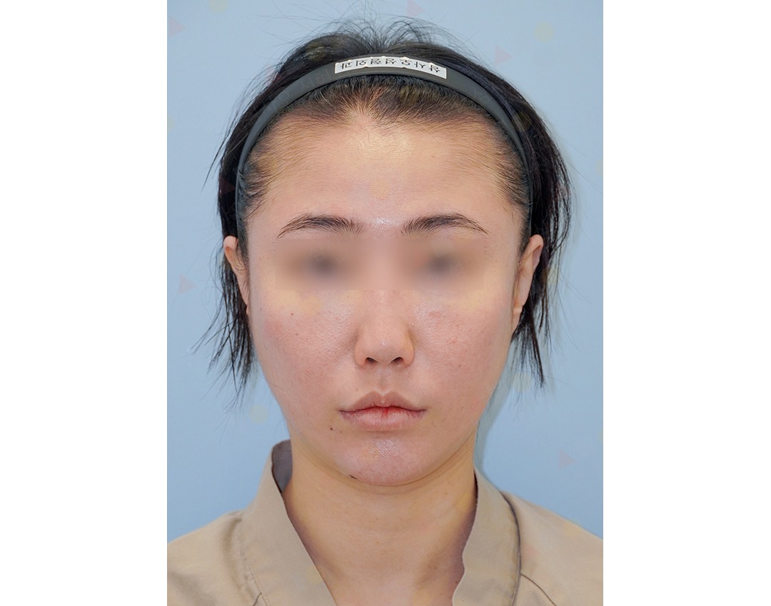 Person before skincare treatment, clear skin visible.