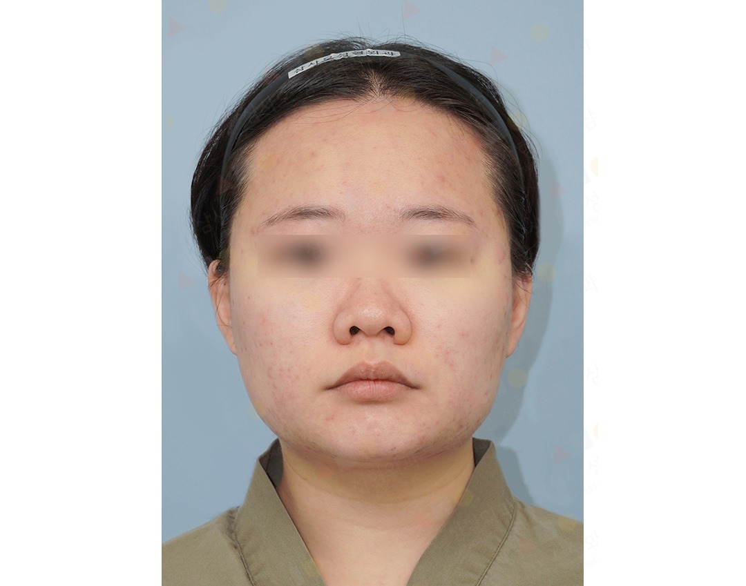 Woman with facial acne, neutral expression.