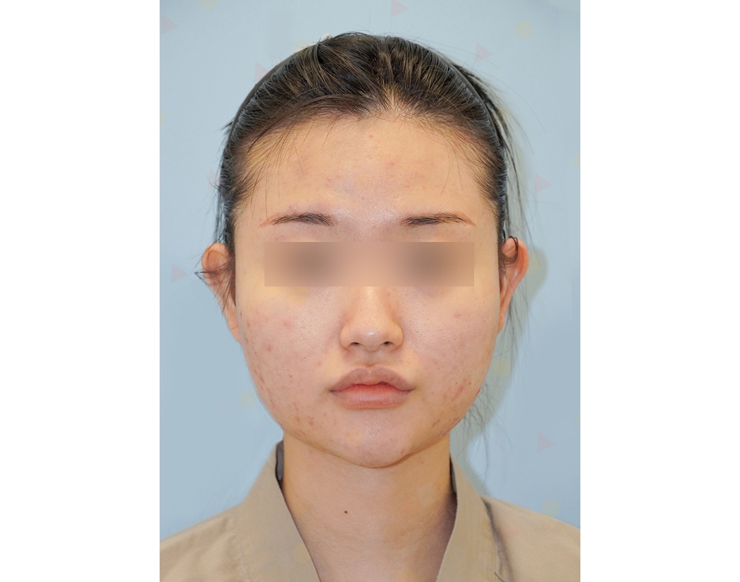 Woman with acne and blurred eyes.